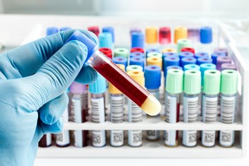 blue gloved hand holding a vial of blood in front of a rack of vials